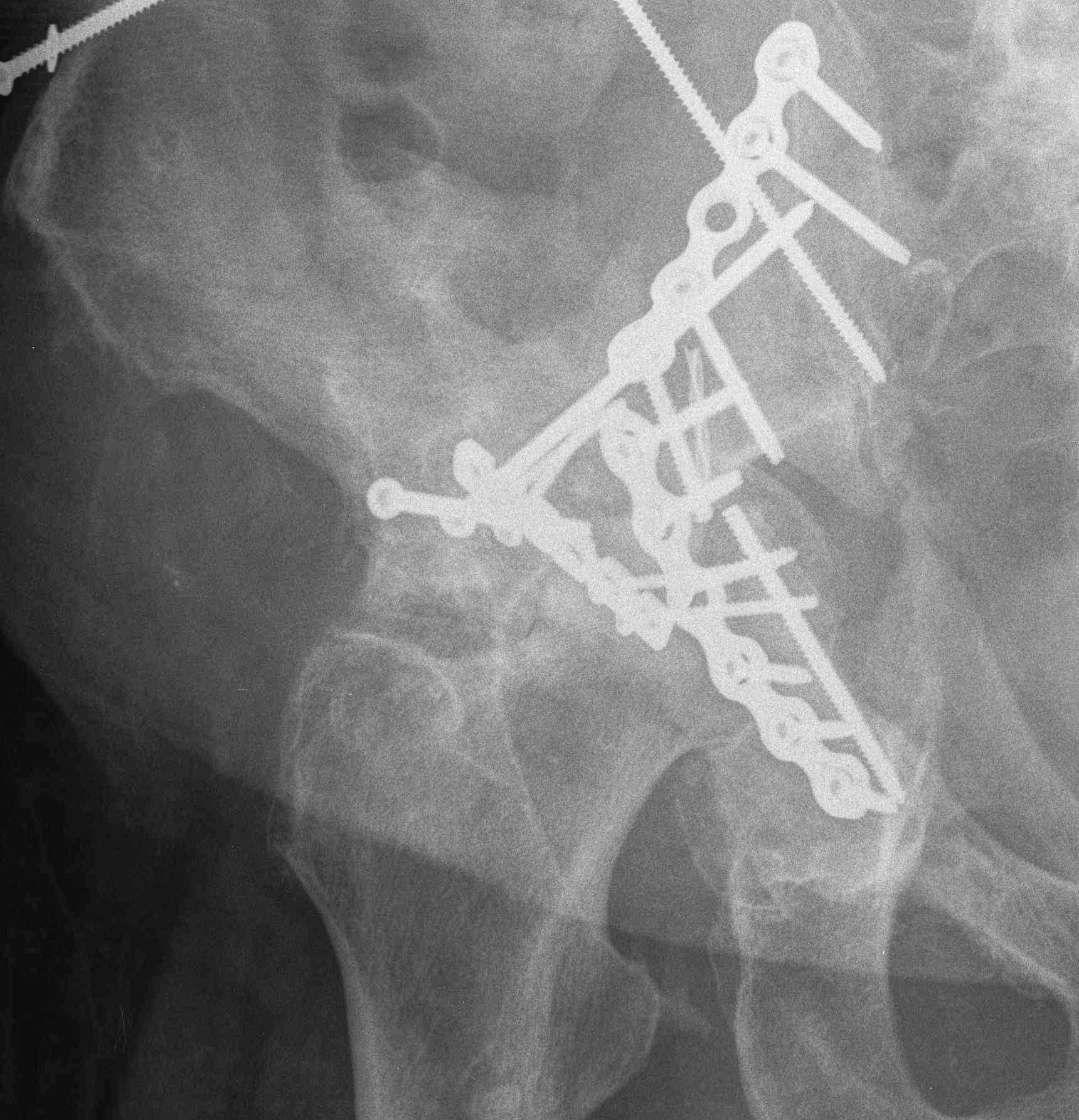 Acetabular Fracture Failed ORIF 1